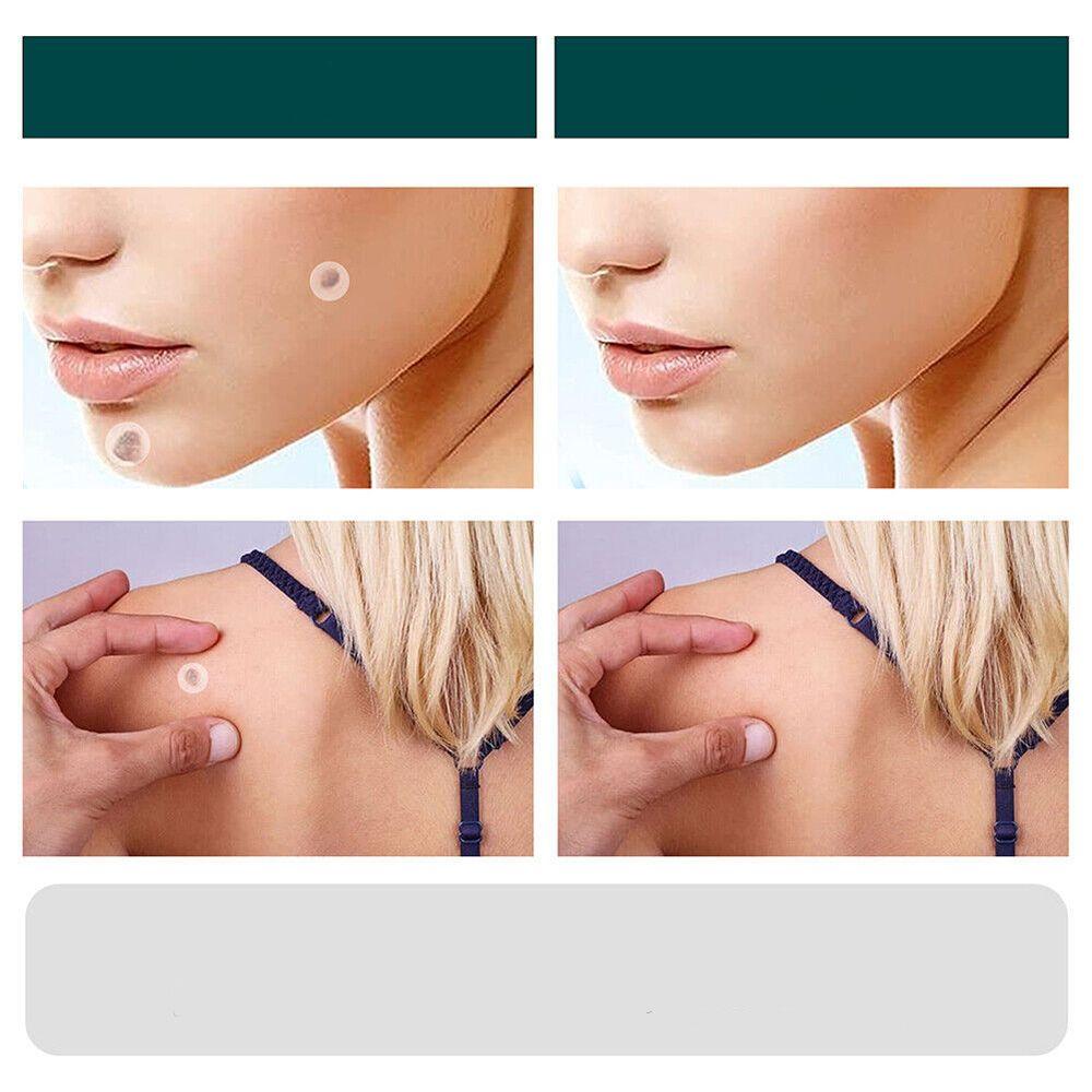 Brehn | SkinClear Skin Tag Remover | Pflaster zur Entfernung von Hautanhängseln & Warzen | Hydrokolloid-Technologie | Schmerzfrei & Diskret | Für alle Hauttypen | 120 Stück