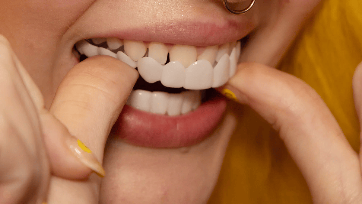Sofortige Verschönerung Ihres Lächelns mit Snap-on-Veneers