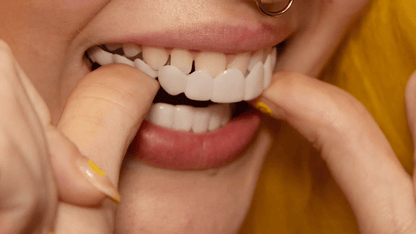Sofortige Verschönerung Ihres Lächelns mit Snap-on-Veneers
