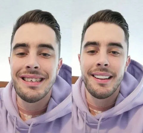 Brehn | On Smile Veneers (Ober- und Unterkiefer inbegriffen)