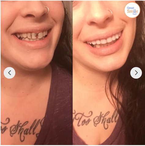- Snap-in Zahnprothese | 1+1 KOSTENLOS!
