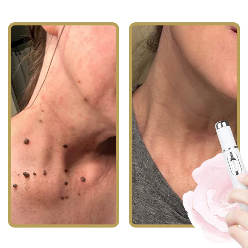 Brehn | ClearDerm - Schnelle, schmerzfreie Pickelentfernung für glatte, klare Haut