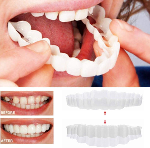 Brehn | On Smile Veneers (Ober- und Unterkiefer inbegriffen)