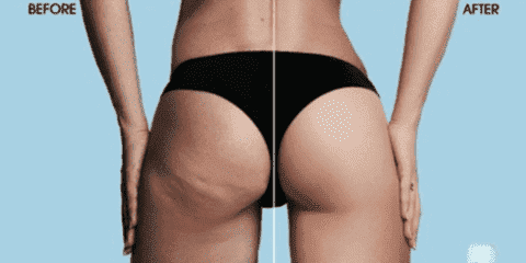Anti-Cellulite-Vakuum-Silikonbecher | Brehn