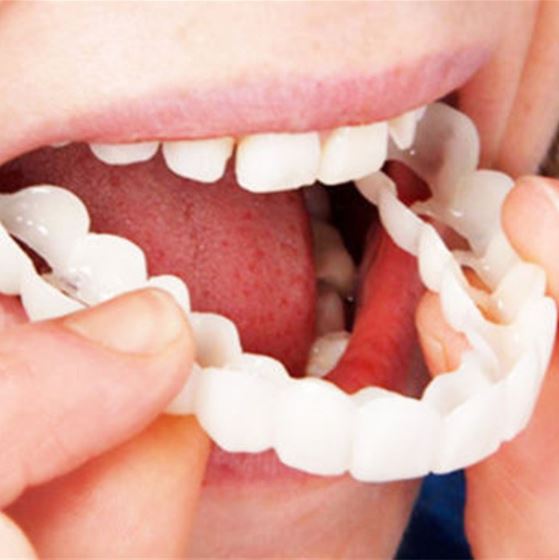 Brehn | SmileSnap Zahnverblendungen – Sofortiges Lächeln mit bequemer Passform