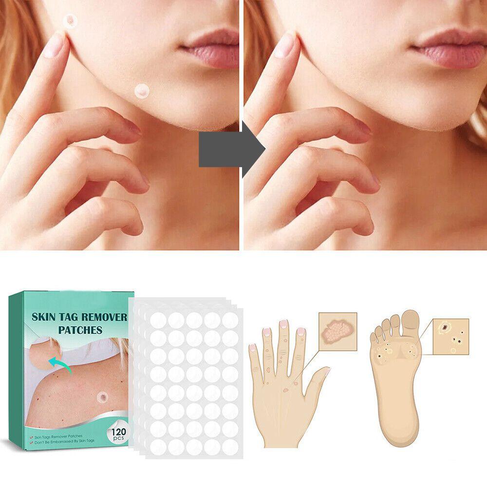 Brehn | SkinClear Skin Tag Remover | Pflaster zur Entfernung von Hautanhängseln & Warzen | Hydrokolloid-Technologie | Schmerzfrei & Diskret | Für alle Hauttypen | 120 Stück