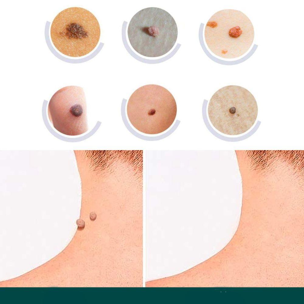 Brehn | SkinClear Skin Tag Remover | Pflaster zur Entfernung von Hautanhängseln & Warzen | Hydrokolloid-Technologie | Schmerzfrei & Diskret | Für alle Hauttypen | 120 Stück
