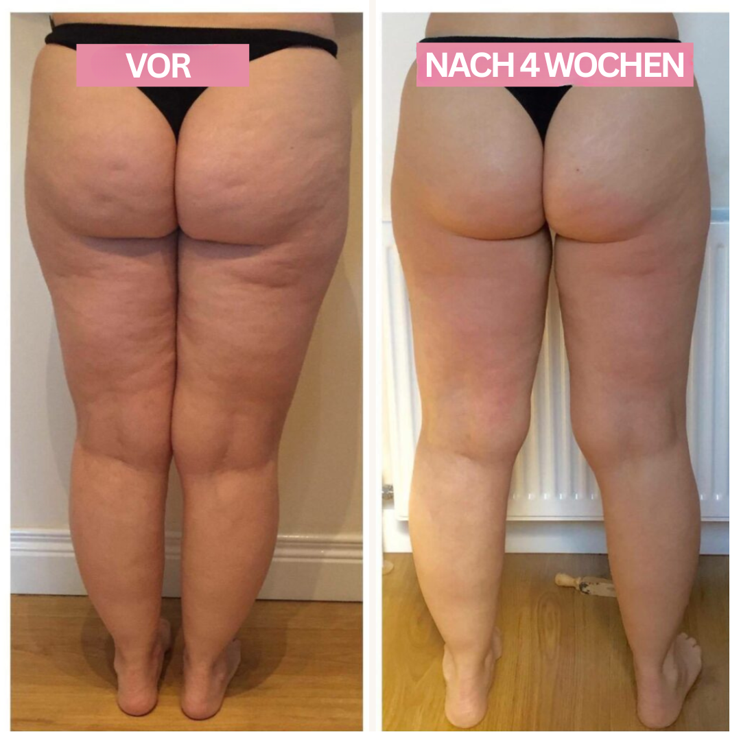 Brehn | Anti-Cellulite-Cupping-Gerät – SlimCupp