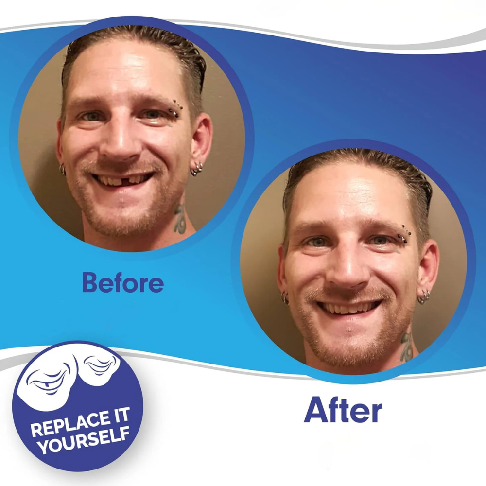 Herausnehmbare Veneers-Zahnverblendschalen