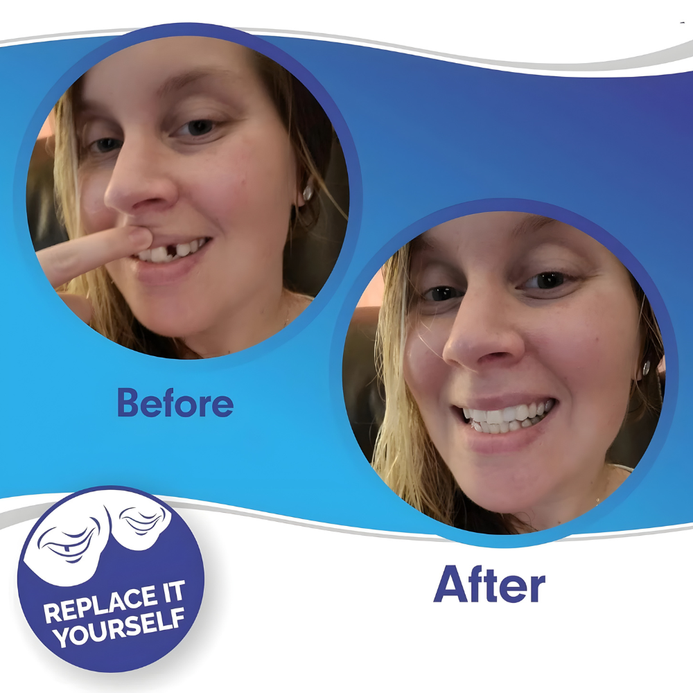 Herausnehmbare Veneers-Zahnverblendschalen