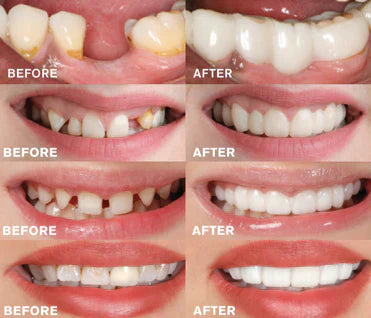 - Snap-in Zahnprothese | 1+1 KOSTENLOS!