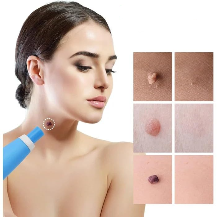 Skin Tag Entferner Kit | Nicht-invasiv & Effektiv | Brehn