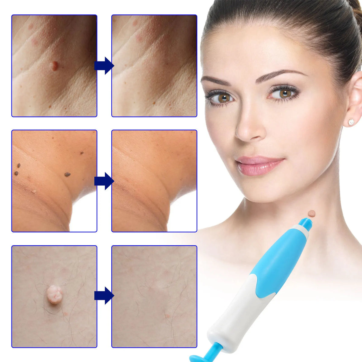 Skin Tag Entferner Kit | Nicht-invasiv & Effektiv | Brehn