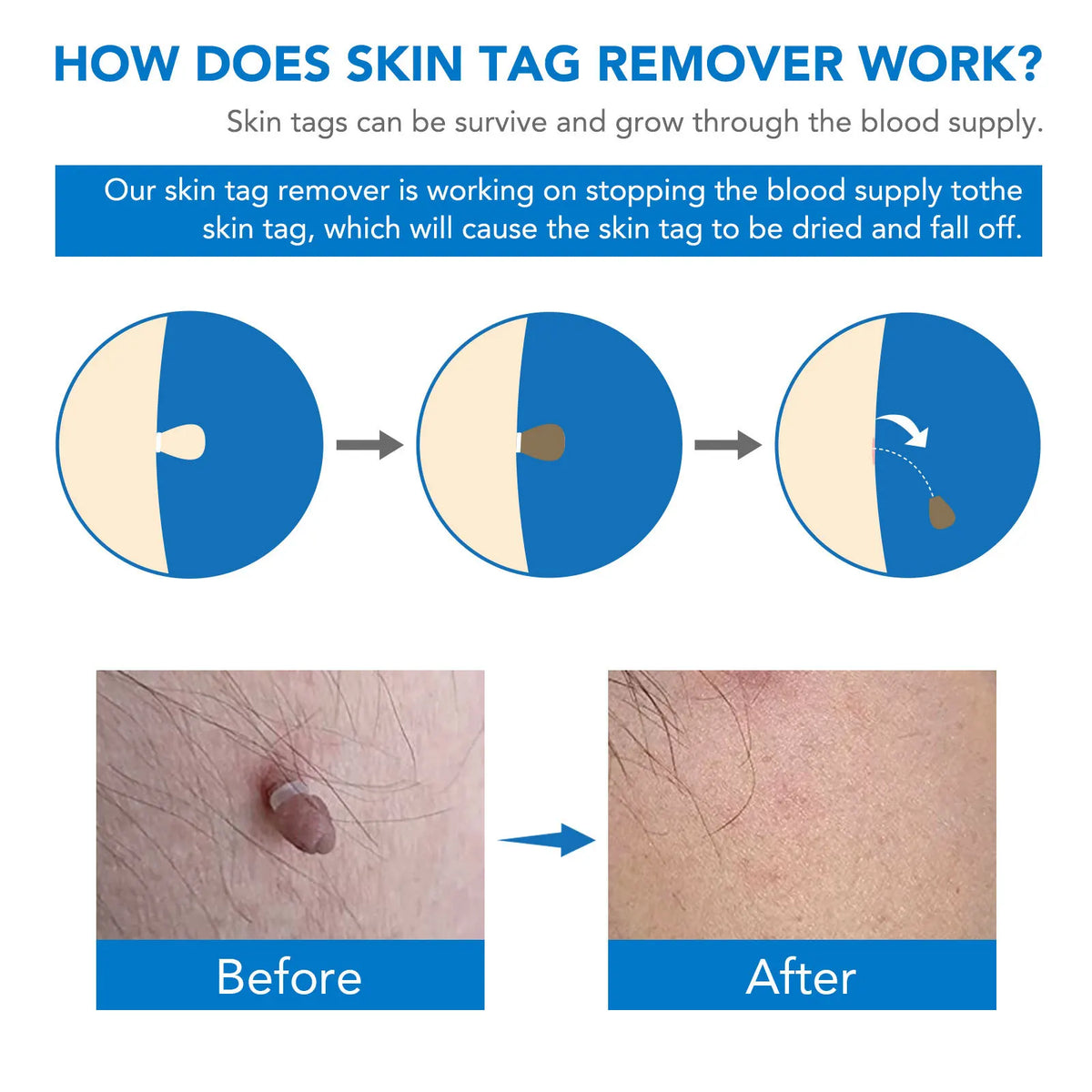 Skin Tag Entferner Kit | Nicht-invasiv & Effektiv | Brehn