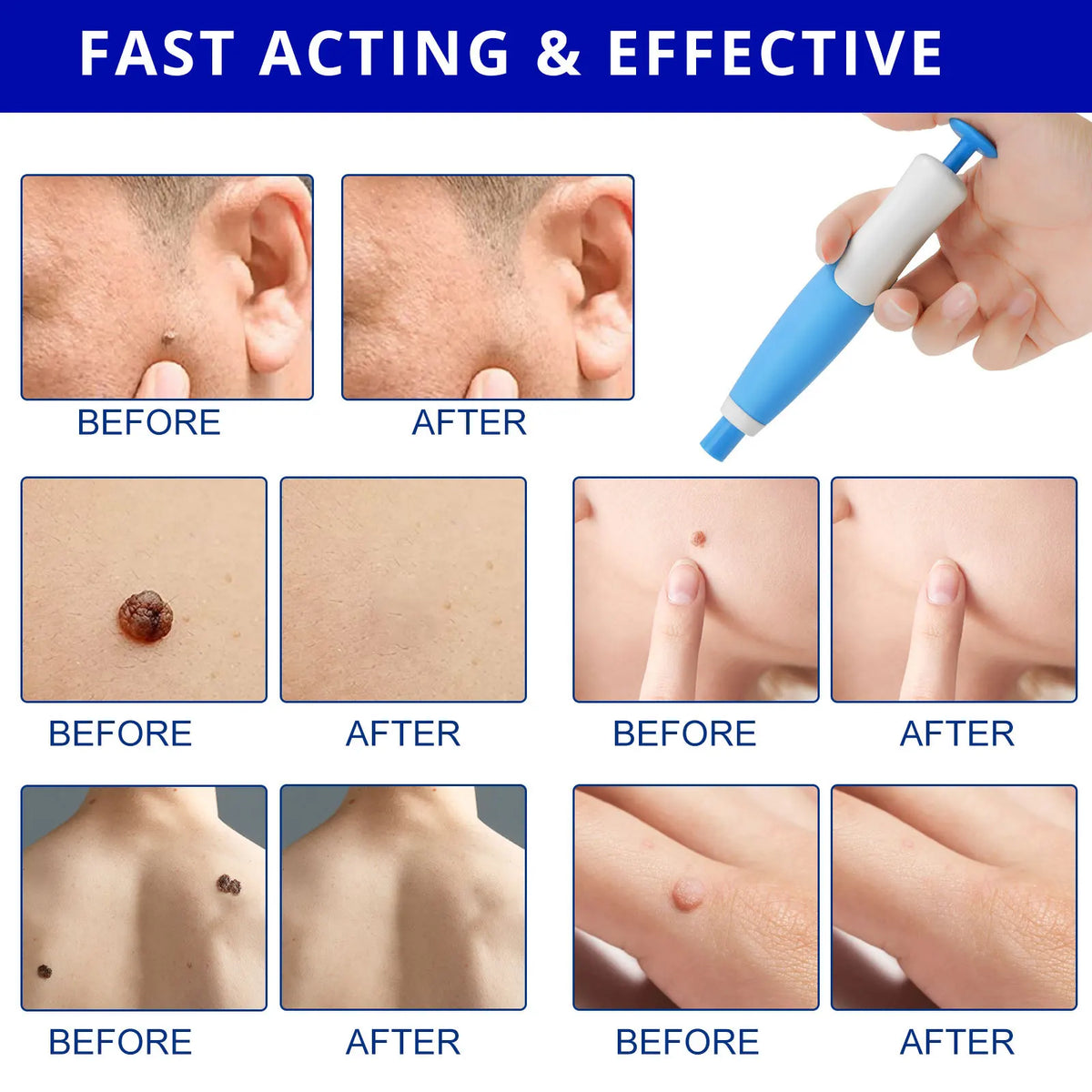 Skin Tag Entferner Kit | Nicht-invasiv & Effektiv | Brehn