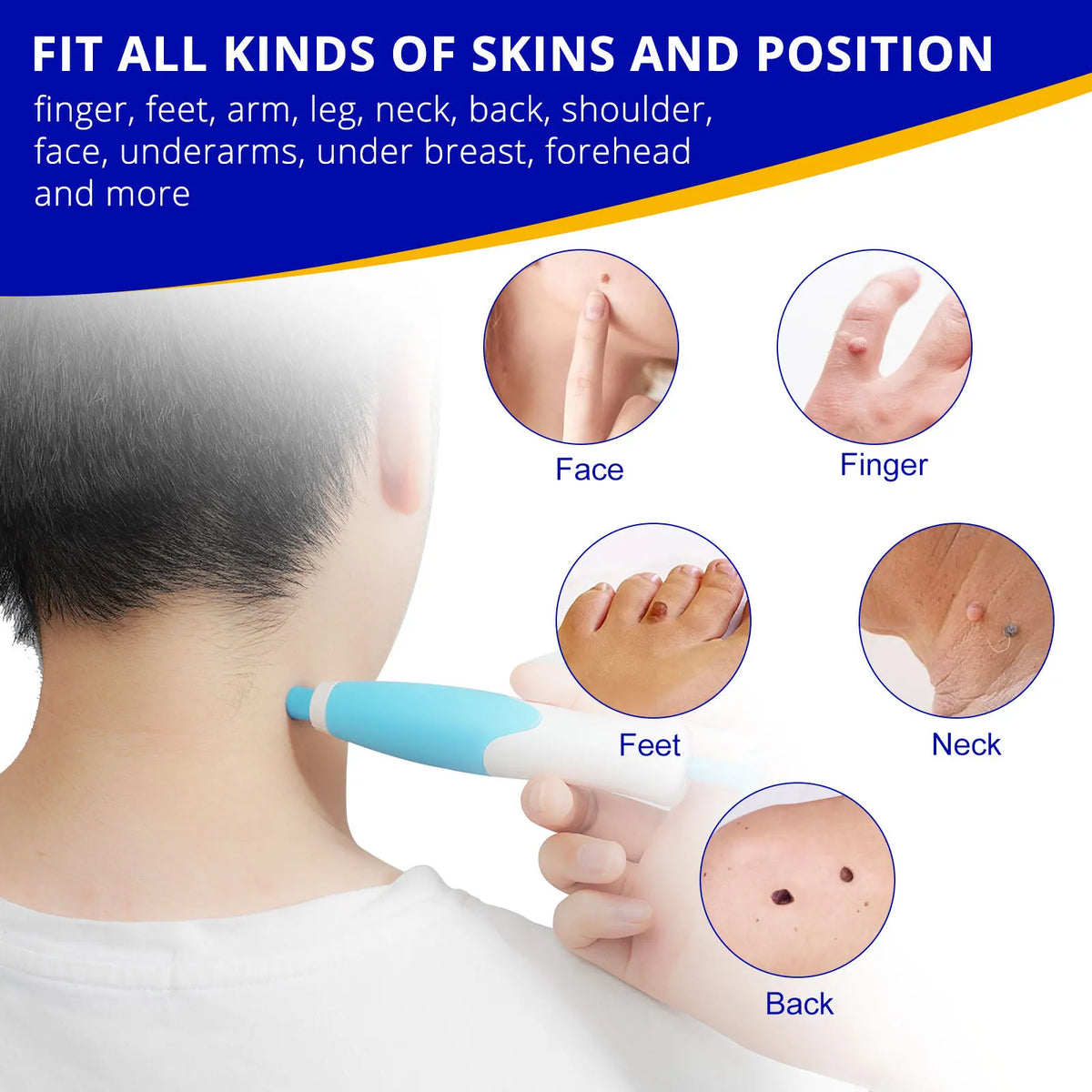 Skin Tag Entferner Kit | Nicht-invasiv & Effektiv | Brehn