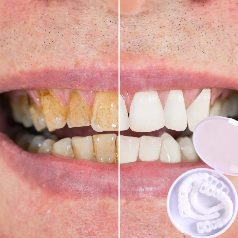 Snap-on Teeth™ – Mit diesen Veneers haben Sie immer ein perfektes Lächeln.
