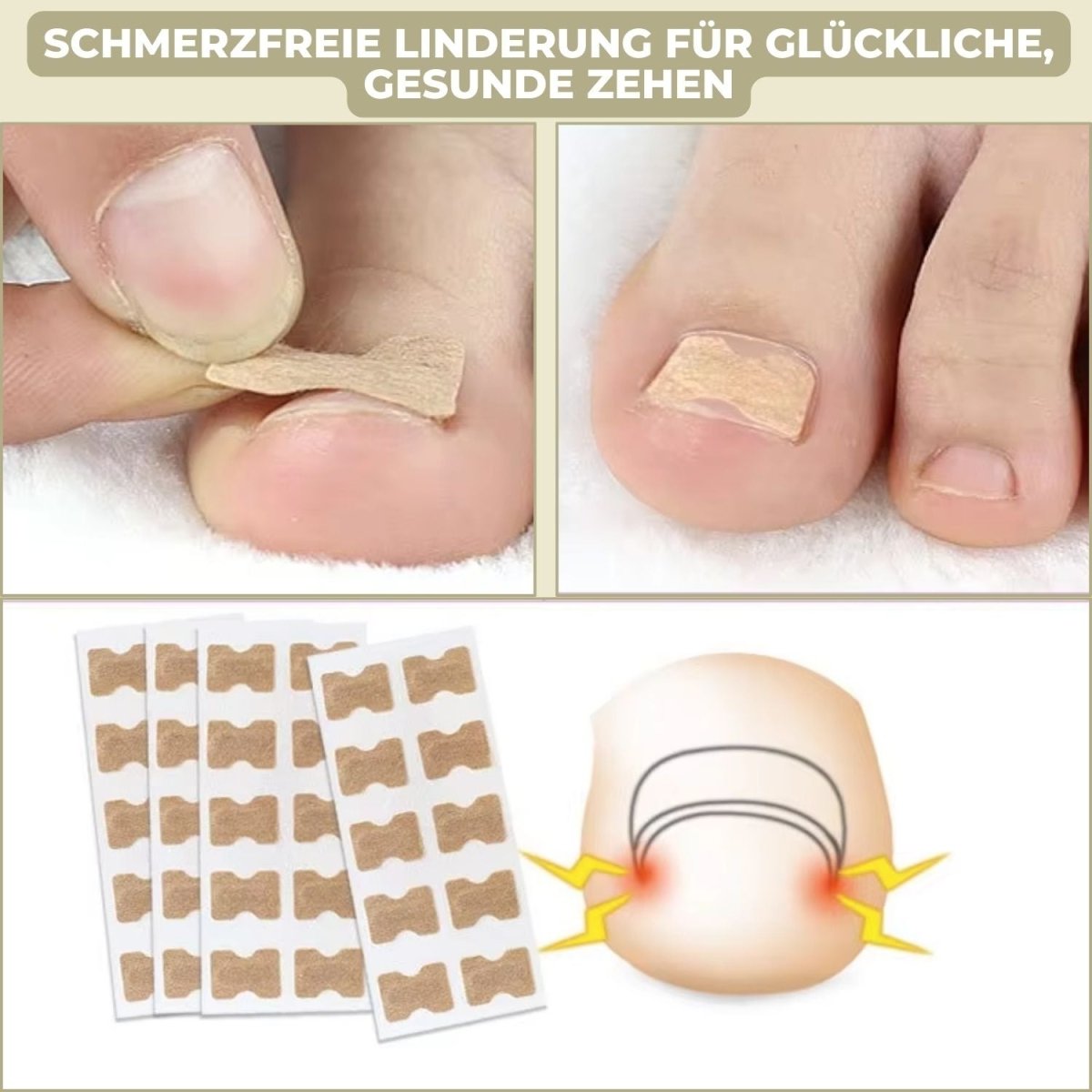 ALIGNSTRIP – Schmerzfreie Nagelkorrekturstreifen für eingewachsene und deformierte Nägel
