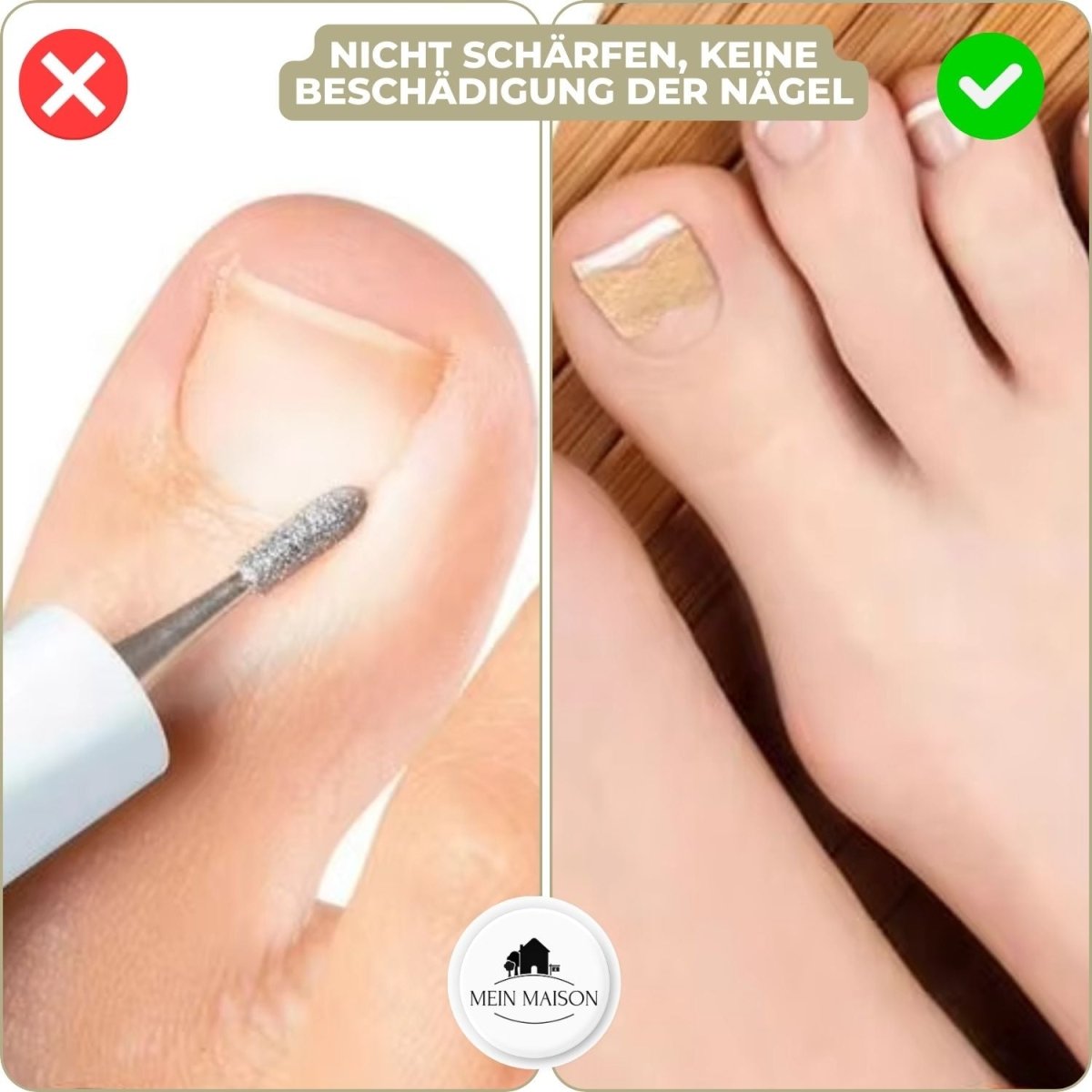 ALIGNSTRIP – Schmerzfreie Nagelkorrekturstreifen für eingewachsene und deformierte Nägel