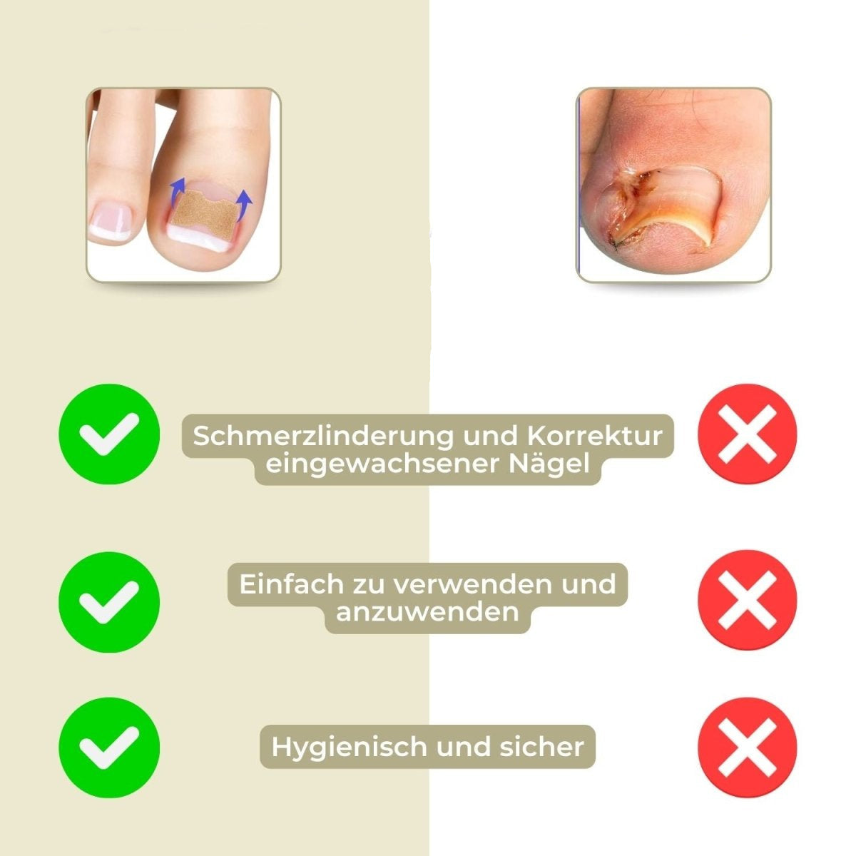 ALIGNSTRIP – Schmerzfreie Nagelkorrekturstreifen für eingewachsene und deformierte Nägel