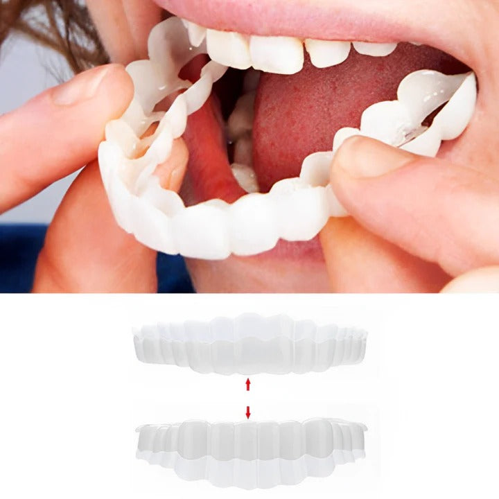 Herausnehmbare Veneers für Ober- und Unterkieferzähne