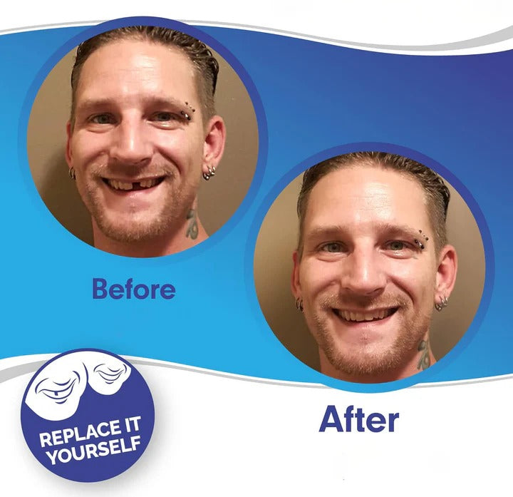 Herausnehmbare Veneers für Ober- und Unterkieferzähne