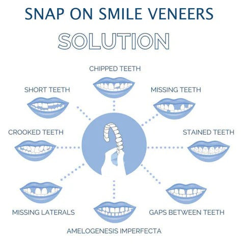 Herausnehmbare Veneers für Ober- und Unterkieferzähne